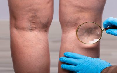 Lasting Confidence Through Varicose Veins Treatment Solutions for Everyday Life